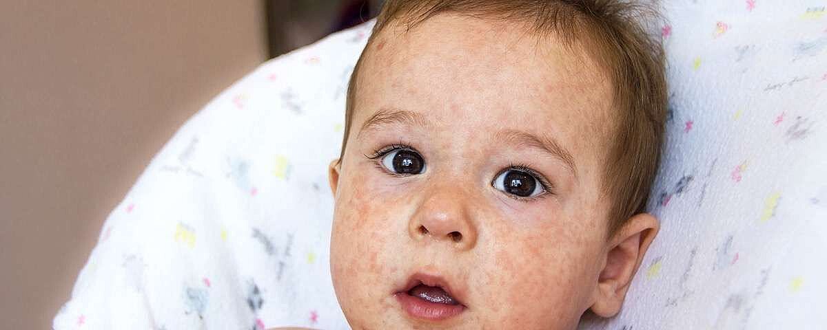 Alergia na pszenicę