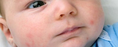 Trądzik niemowlęcy i wypryski na twarzy