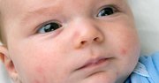 Trądzik niemowlęcy i inne wypryski na twarzy niemowlęcia - jak je rozróżnić i zwalczyć?
