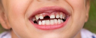 Przebarwienia zębów u dzieci