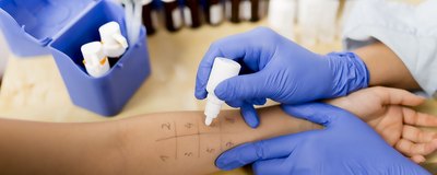 Alergiczne testy skórne. Jak się przygotować i kiedy je zrobić?