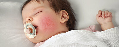 Szkarlatyna u dziecka - objawy, leczenie, powikłania