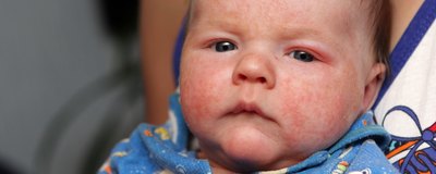 Alergia u niemowląt objawy