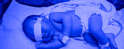 Bilirubina u noworodka - objawy rodzaje normy